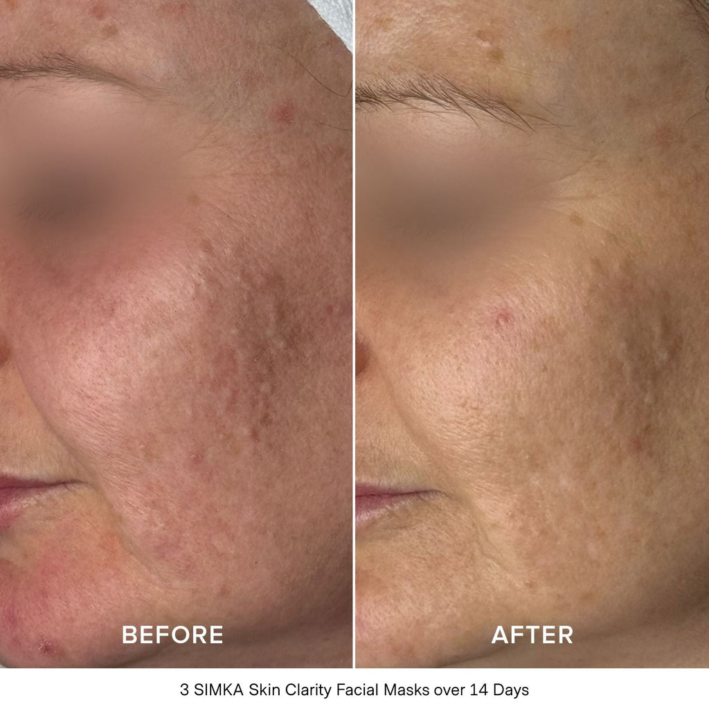 SIMKA Skin Clarity Bio-Cellulose Mask