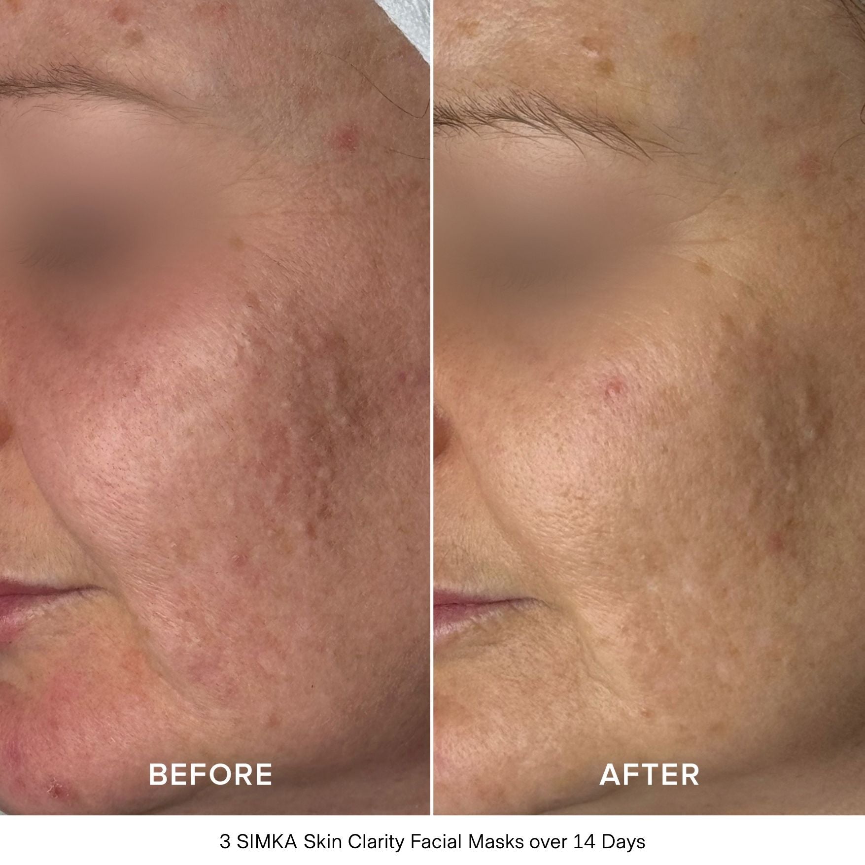 SIMKA Skin Clarity Bio-Cellulose Mask